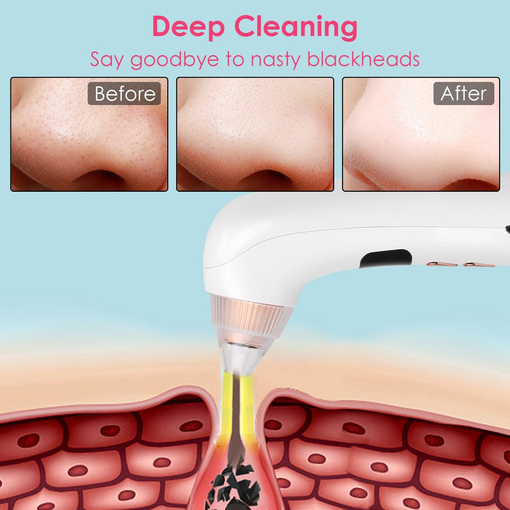 Blackhead Vacuum Remover Acne Remover